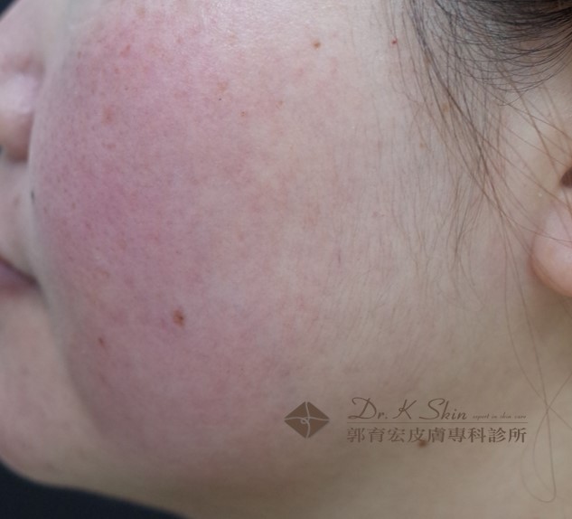 紅斑血管擴張型玫瑰斑