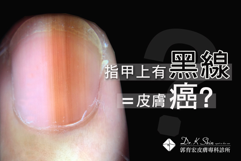 縱向黑甲症